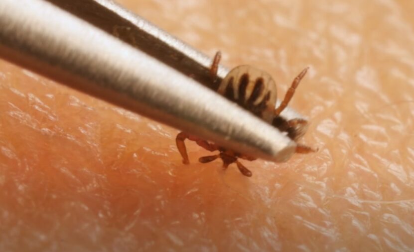 How to Remove Tick From Skin